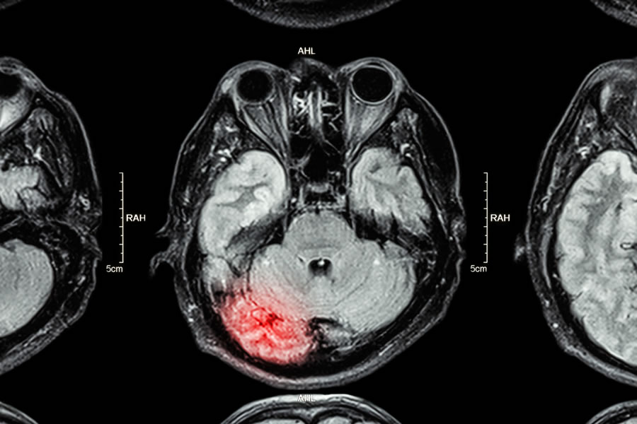 Compensation for Head and brain injuries