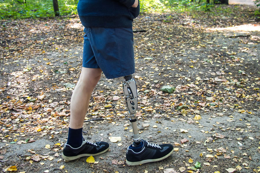 Limb Loss Injuries Allan McDougall Solicitors